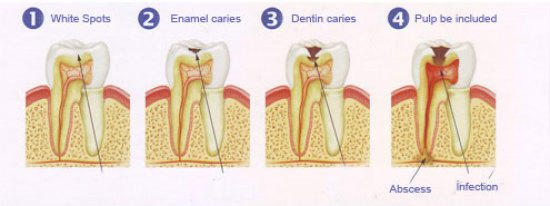 dental caries progression