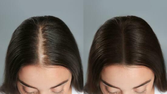 Regenera Activa for Hair Loss: A Revolutionary Autologous Solution for Thinning Hair