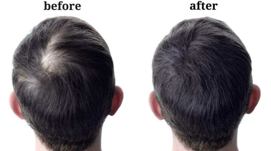 Discover the Power of Exosome Hair Treatment in Bhubaneswar at Radiance Skin & Hair Clinic