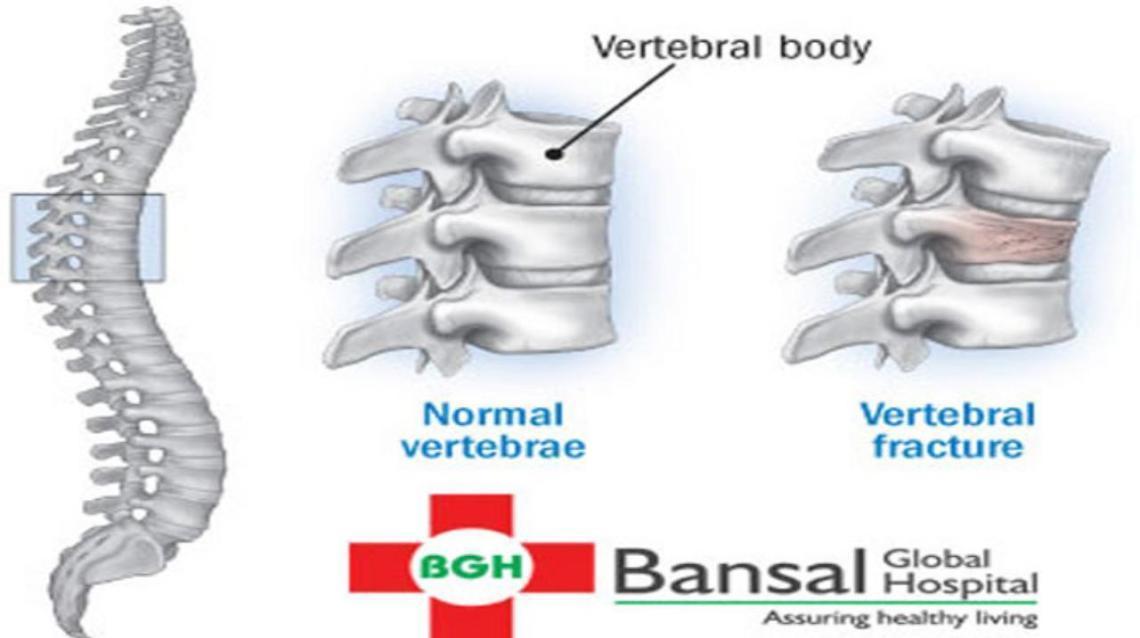 Vertebrae Fracture in Osteoporosis