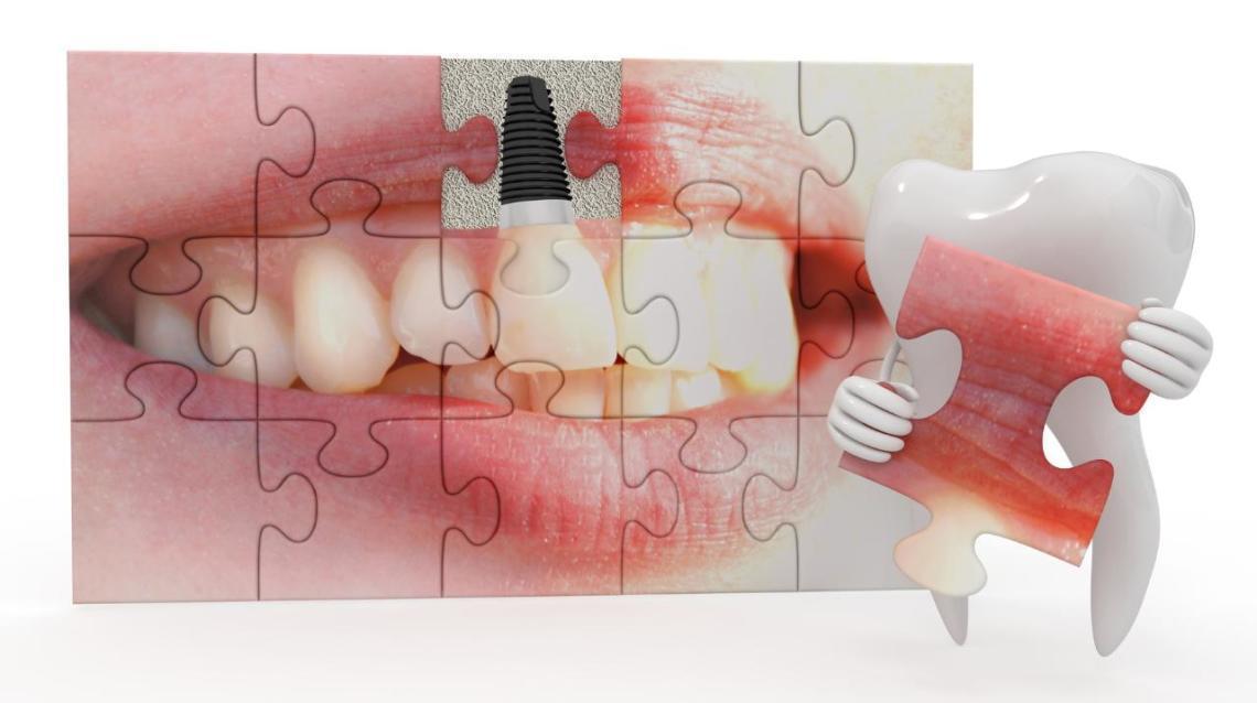 How Are Dental Implants Made?