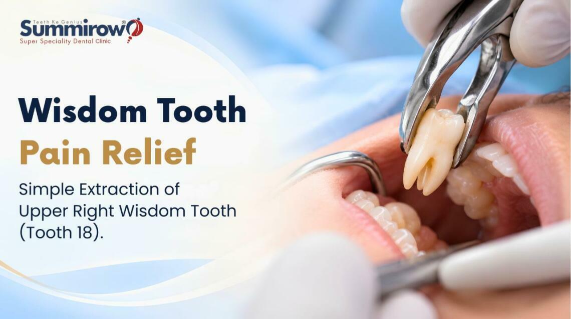 Upper Right Wisdom Tooth Pain Relief - Simple Extraction Case