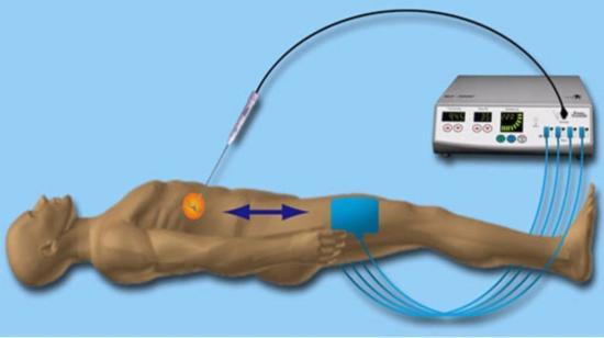 Bu​​​​rn the Cancer Through a Small Pinhole