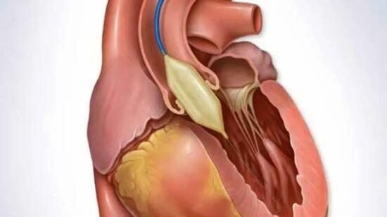 Balloon Valvuloplasty: A Minimally Invasive Treatment for Heart Valve Disease