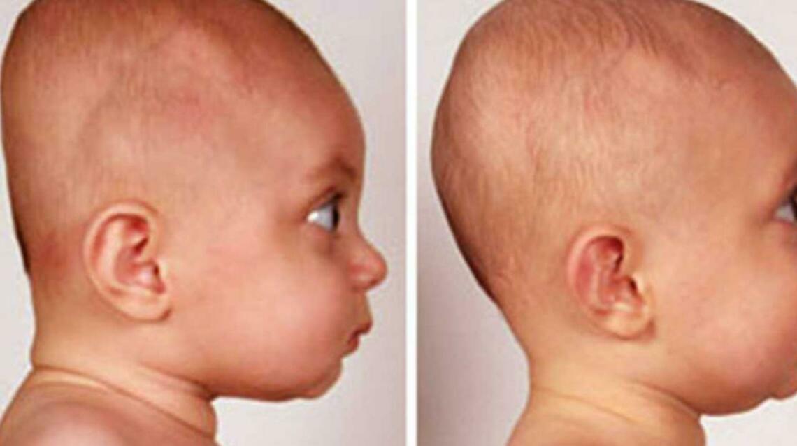 Flat Head Syndrome in Infants.