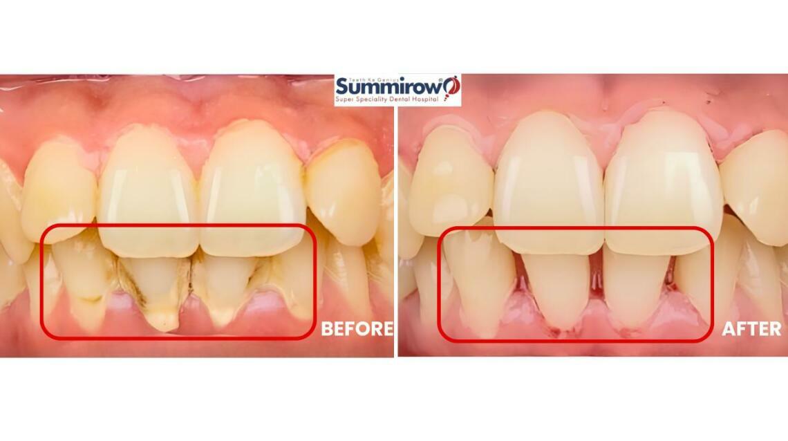 Scaling & Polishing: A Happy Smile Transformation at Summirow Dental Hospital