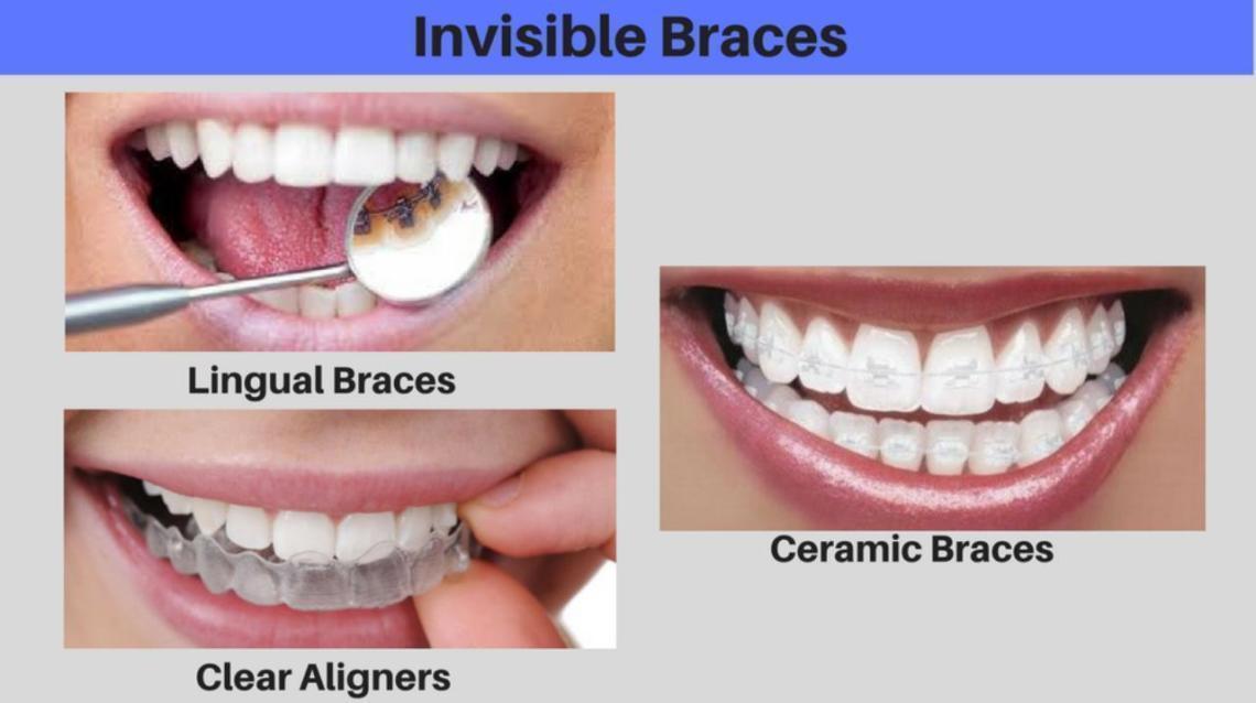 Invisible Braces Free Consultation With Your Friendly Orthodontist