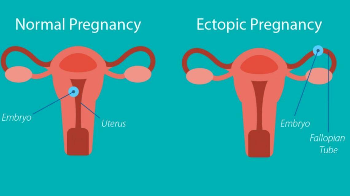 Two Pink Lines Can Turn Into Two Litres of Blood - Early ultrasound.early Diagnosis. Safe Motherhood