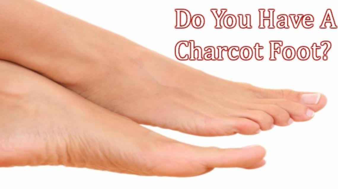 If You Are Diabetic, Watch Out for Charcot Foot