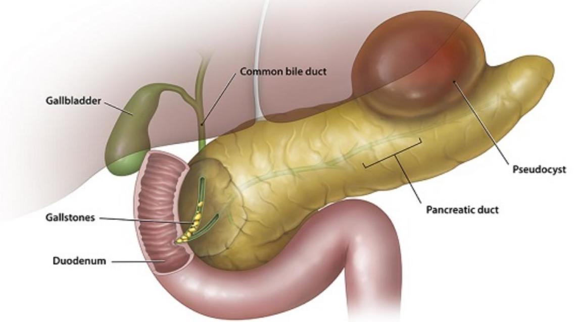 Pancreatitis
