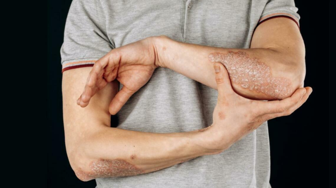 Eczema Made Easy by Ayurveda