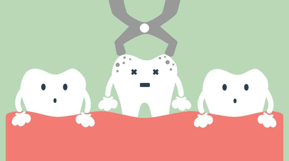 Tooth Extraction After Care