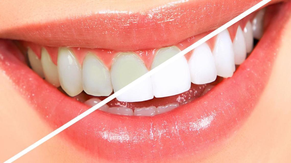 Teeth Whitening Do’s /Don’ts