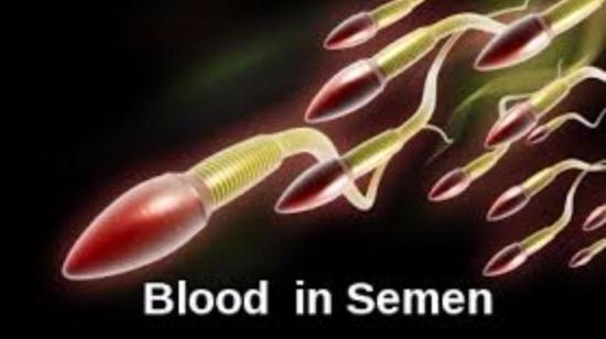 Blood in Semen - Is It a Cause for Worry ?