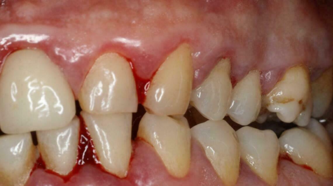 5 Early Warning Signs of Gum Disease You Should Never Ignore