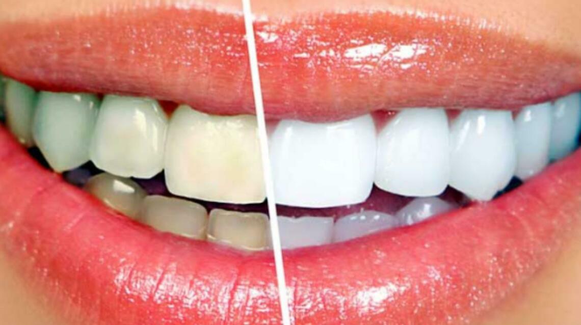 Teeth Whitening: Myths, Facts, and Safety Tips