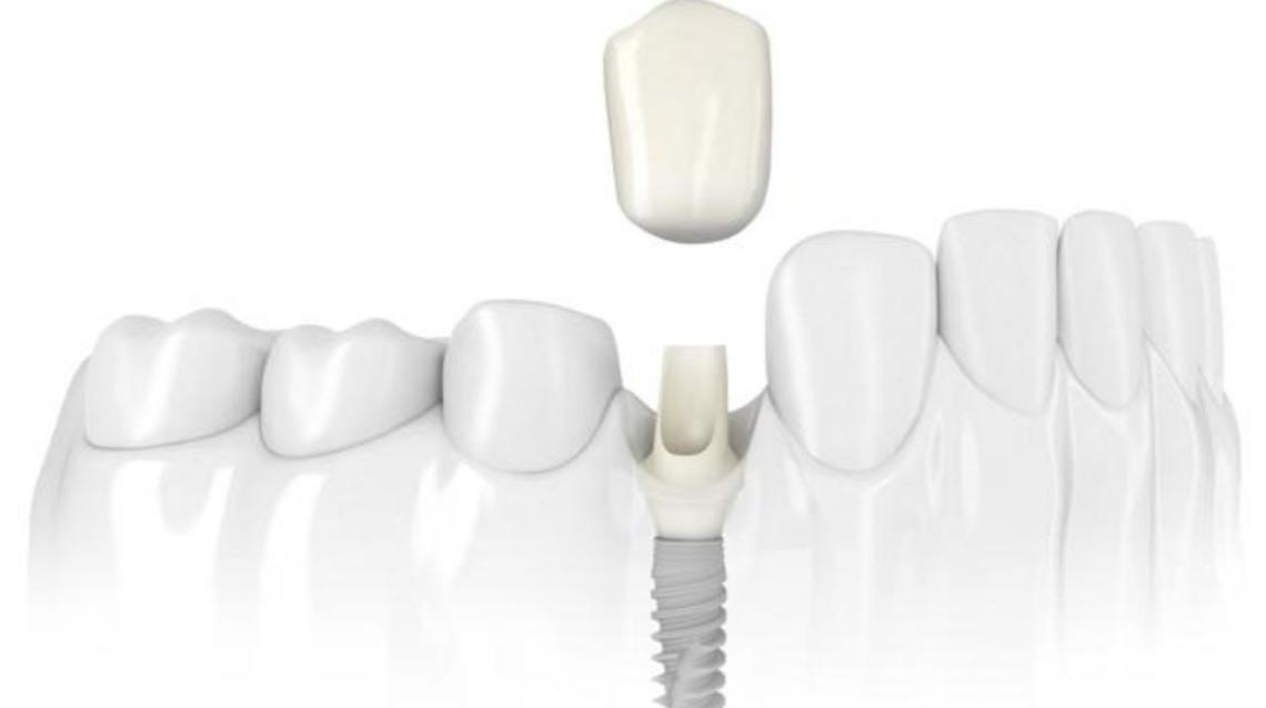 How Much Dental Implant Costs in India?