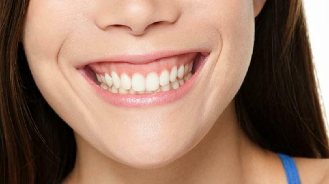 What Do You Need to Know About Gummy Smiles?