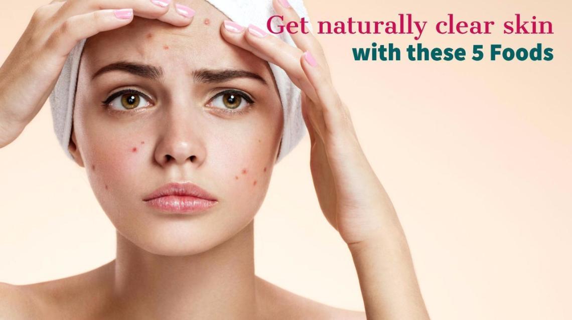 5 useful foods for reducing acne 7e655cc9eb51c4ace2c2ebee140fc613c7913f5c