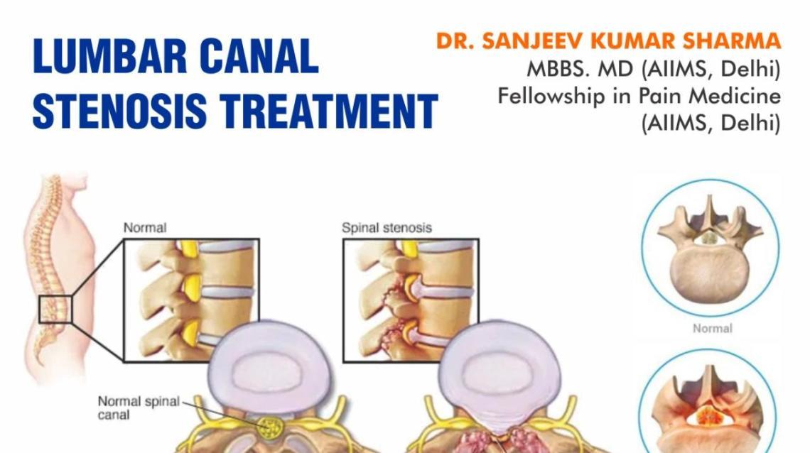 Lumbar Canal Stenosis