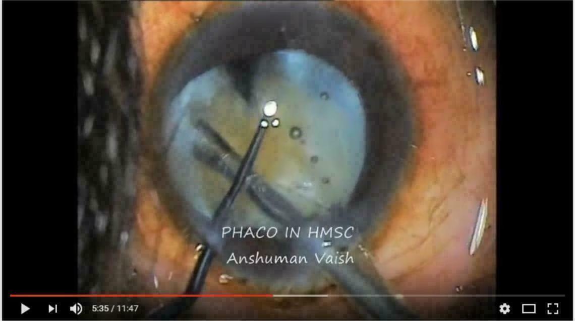 What Is Phaco Cataract Surgery? – FTTQY