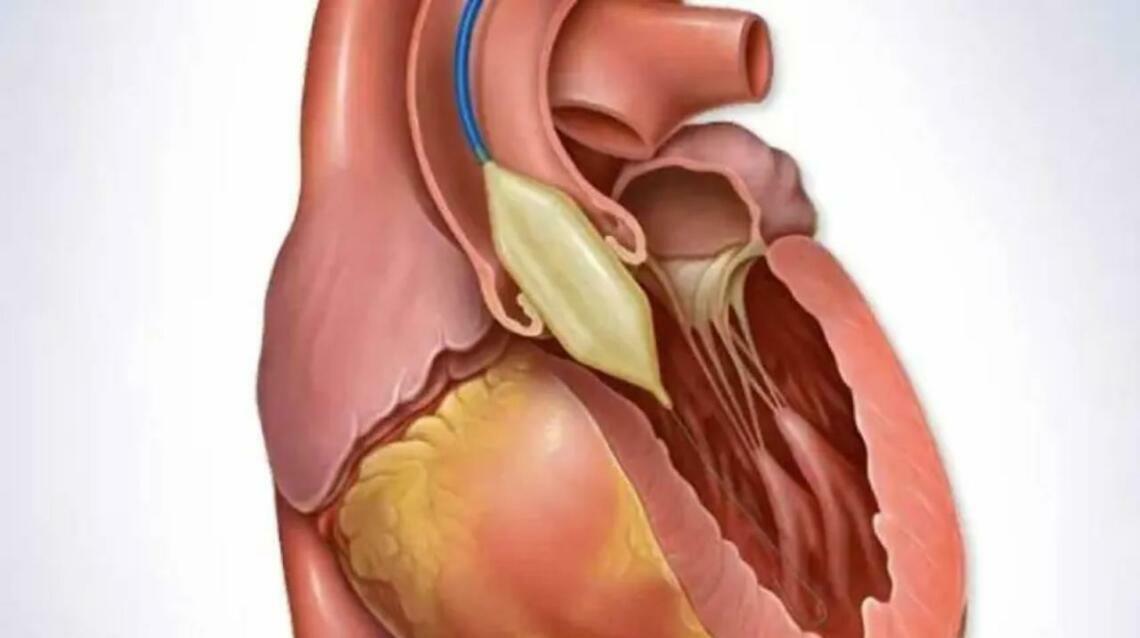 Balloon Valvuloplasty: A Minimally Invasive Treatment for Heart Valve Disease