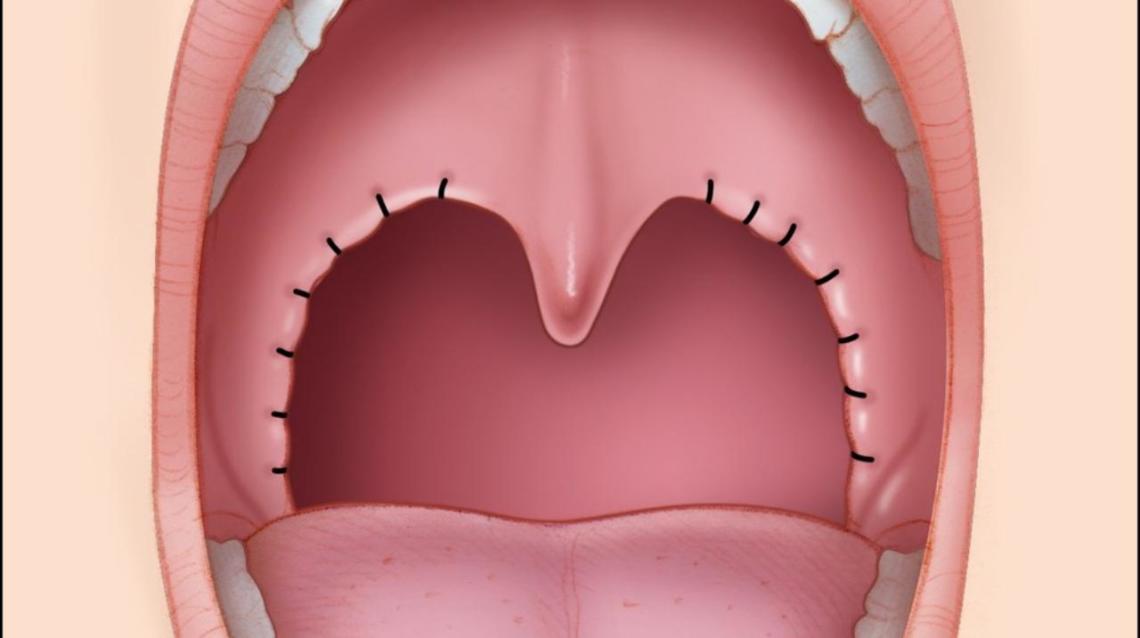 Indications for Tonsillectomy
