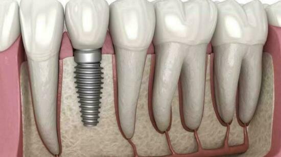 4 Reasons for Key Hole Dental Implant Placement