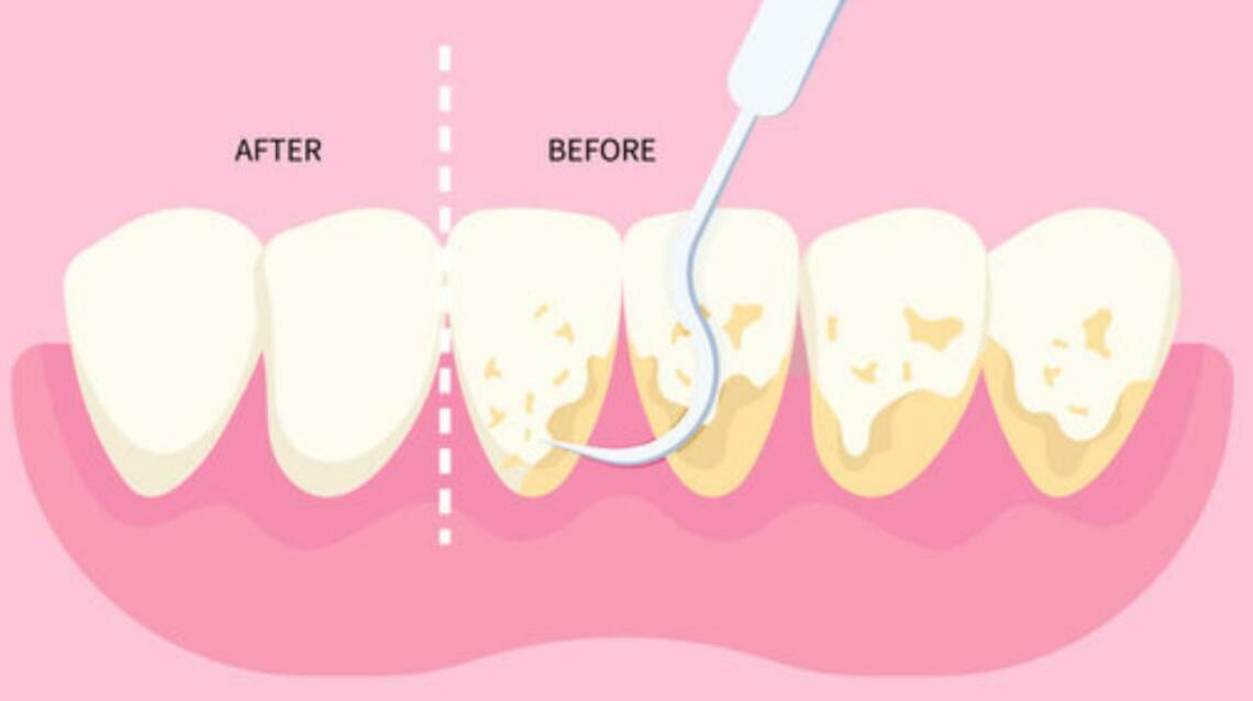 Confused on What to Do After Getting Cleaning of Teeth?