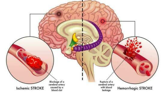7 Early Warning Signs of Stroke You Should Never Ignore