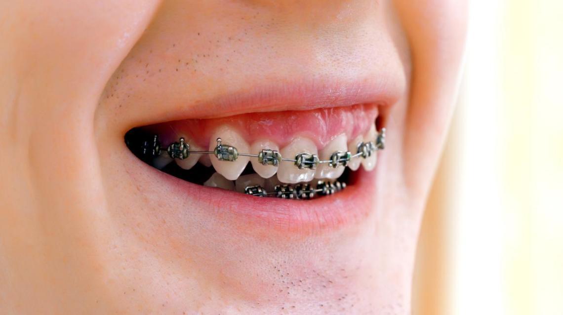 What Is the Best Age for Braces(orthodontic Treatment)?