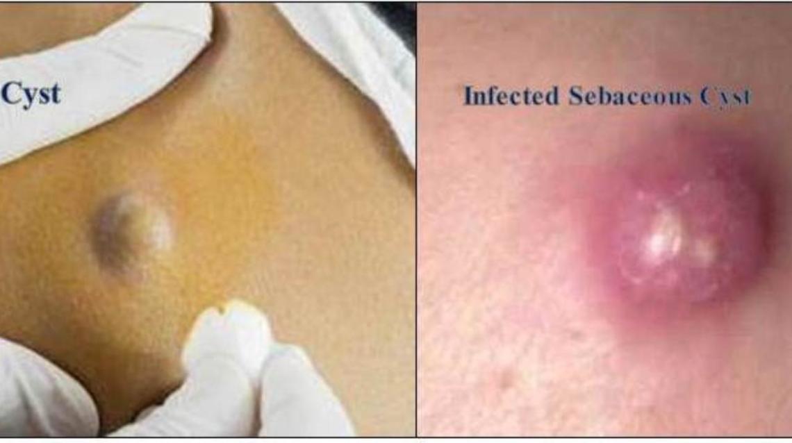 Sebaceous Cyst Causes And Treatment