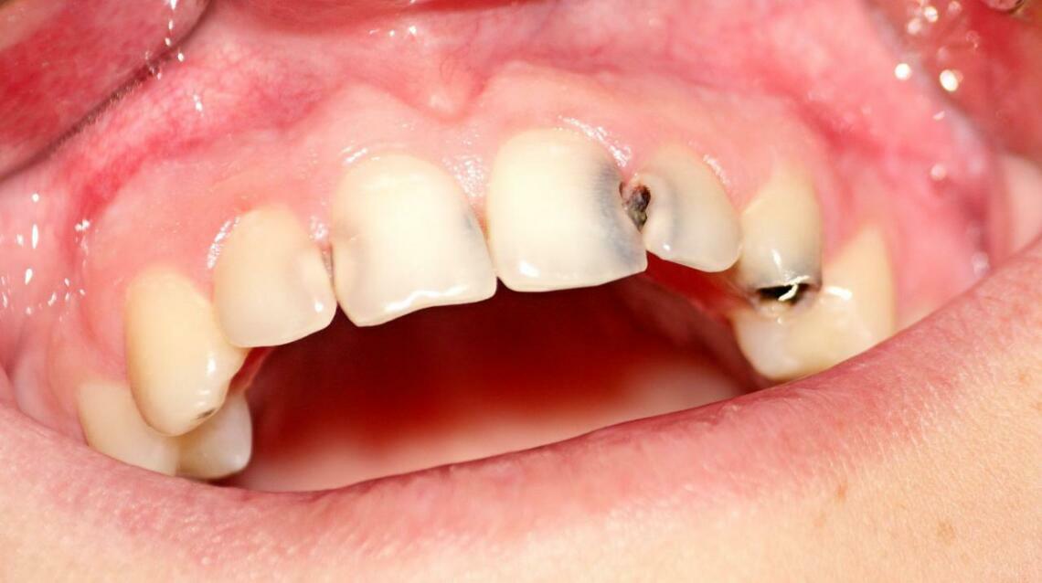 Decay in Between the Teeth Proximal Caries