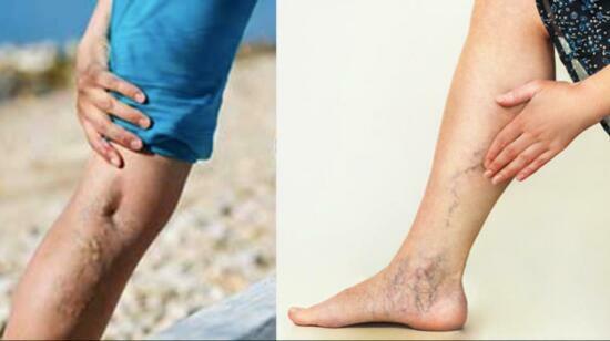 Varicose Veins and Chronic Venous Insufficiency - Latest Advances in Treatment