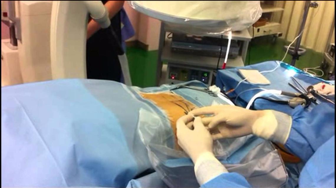 Percutaneous Endoscopic Lumbar Discectomy