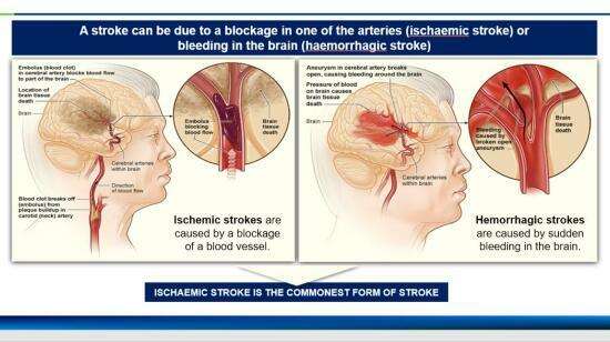Warning Signs of Stroke Which Usually Are Missed by Patients.