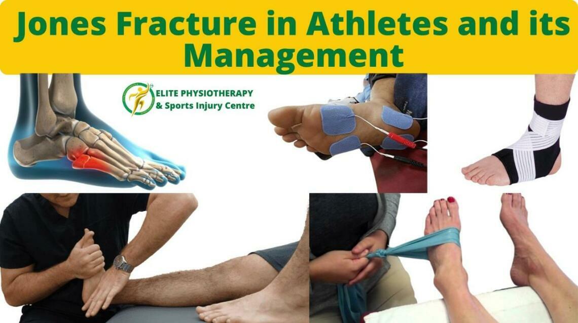 Jones Fracture in Athletes and Its Management