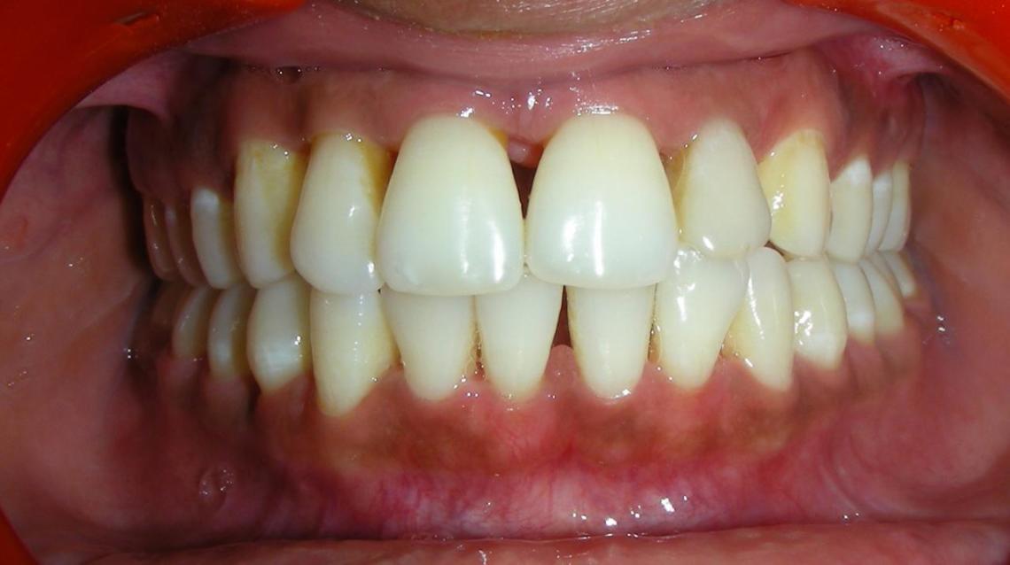 Black Triangles of Teeth