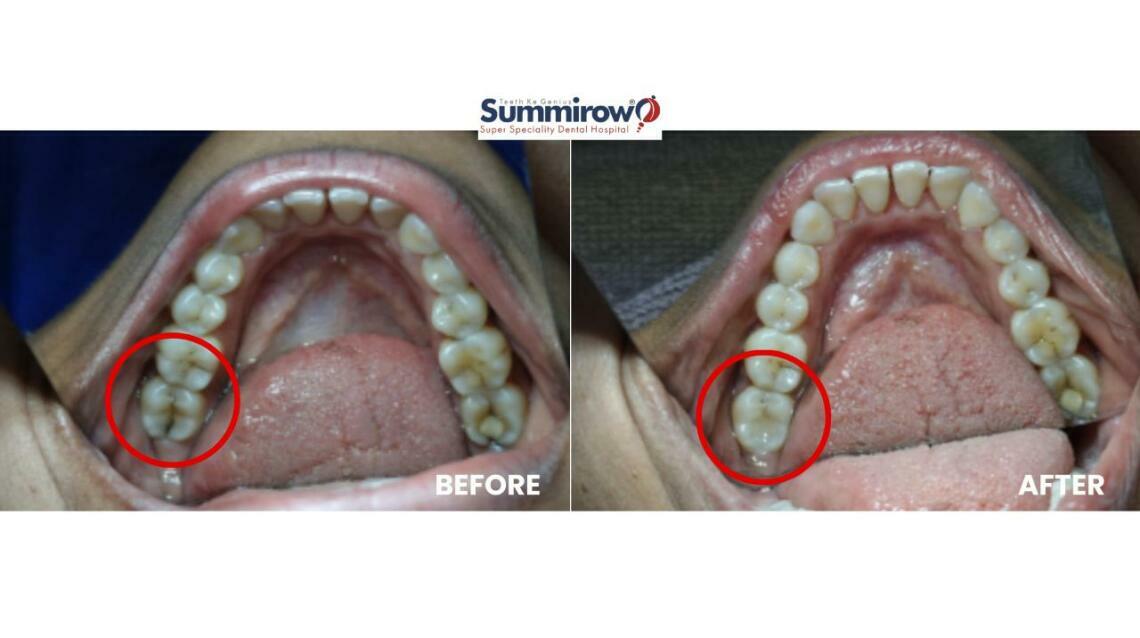 Cracked Tooth Treatment With Sdr Composite Filling: A Conservative Solution for Tooth Sensitivity
