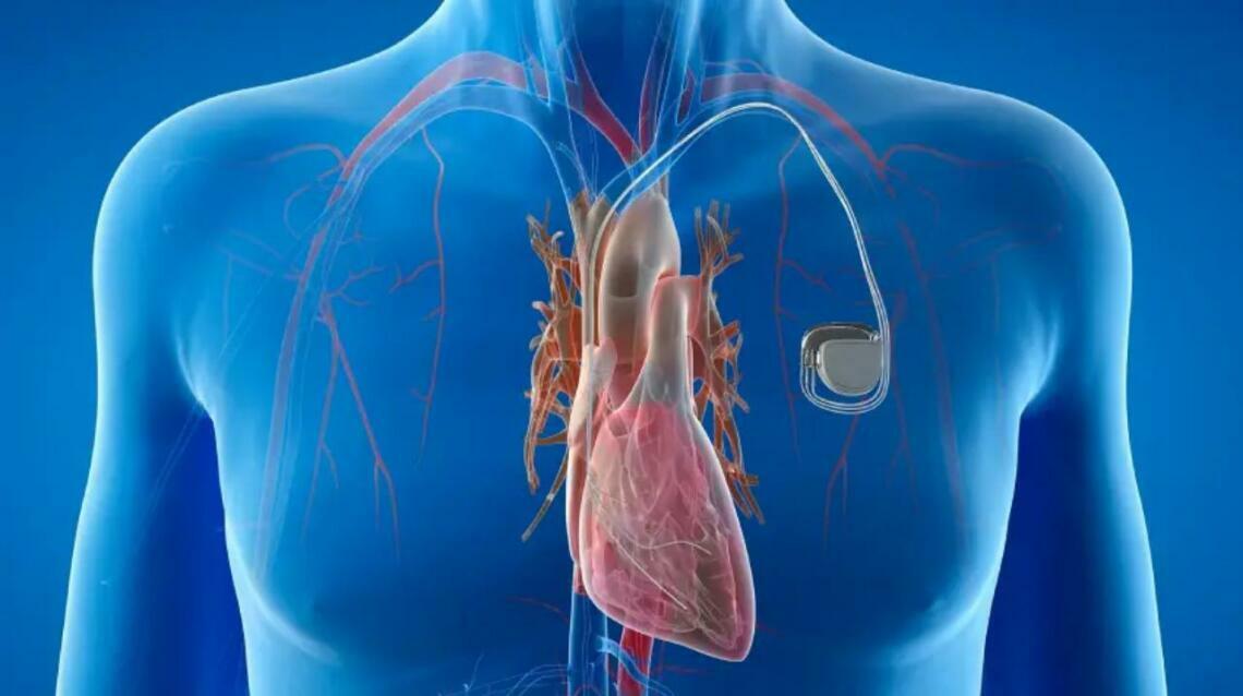 How a Pacemaker Can Improve Your Heart Health?