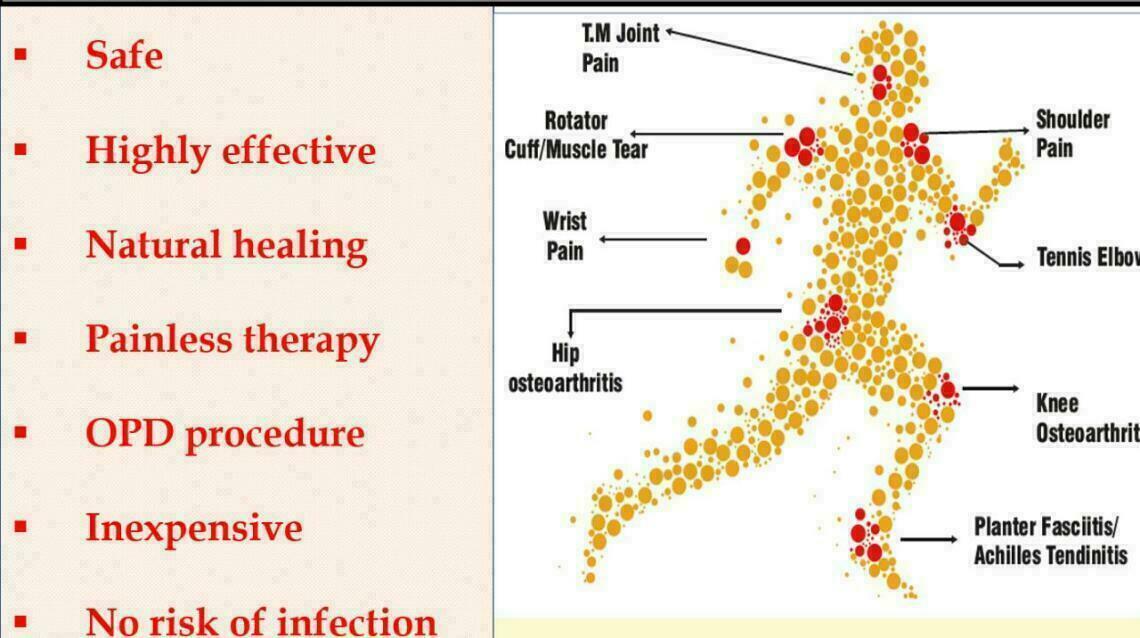 Acl Tear Treatment With Prp (Platelet Rich Plasma Injections)