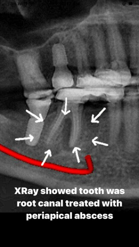 Periapical Abscess Radiograph Preoperative Radiograph Of Tooth 46