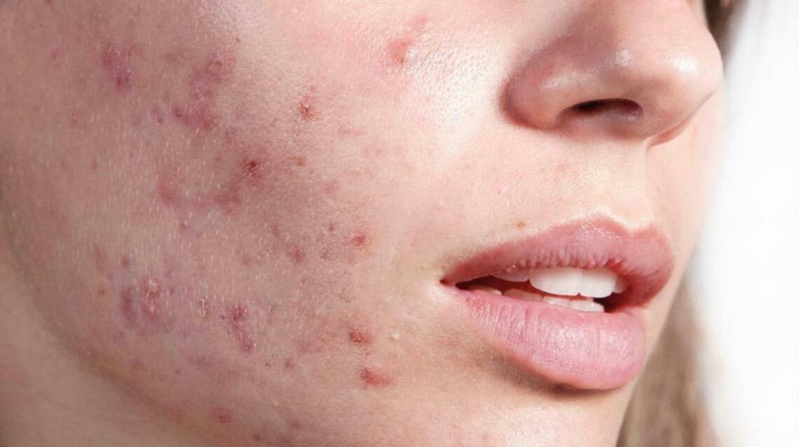Why Adult Acne Is Increasing in Women — the Hormone Imbalance Story