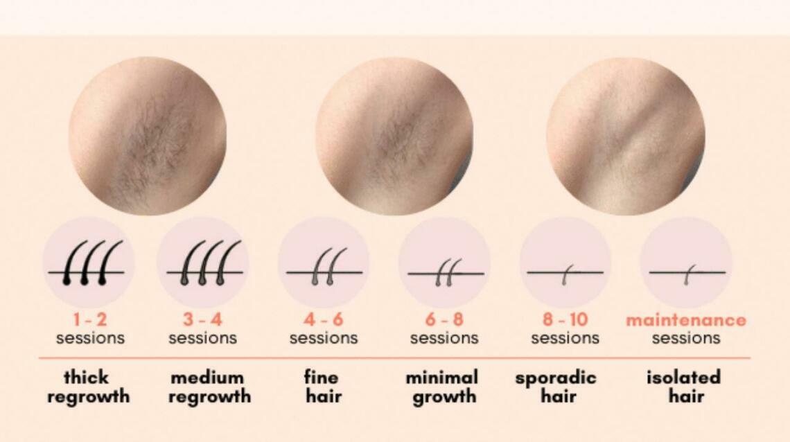 Laser Hair Reduction : Why Some Patients Need More Sessions Than Others.