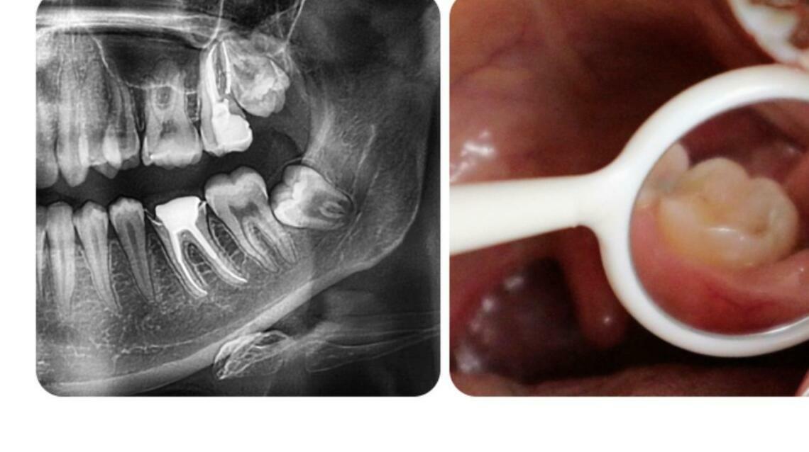 Surgical Removal of Wisdom Tooth