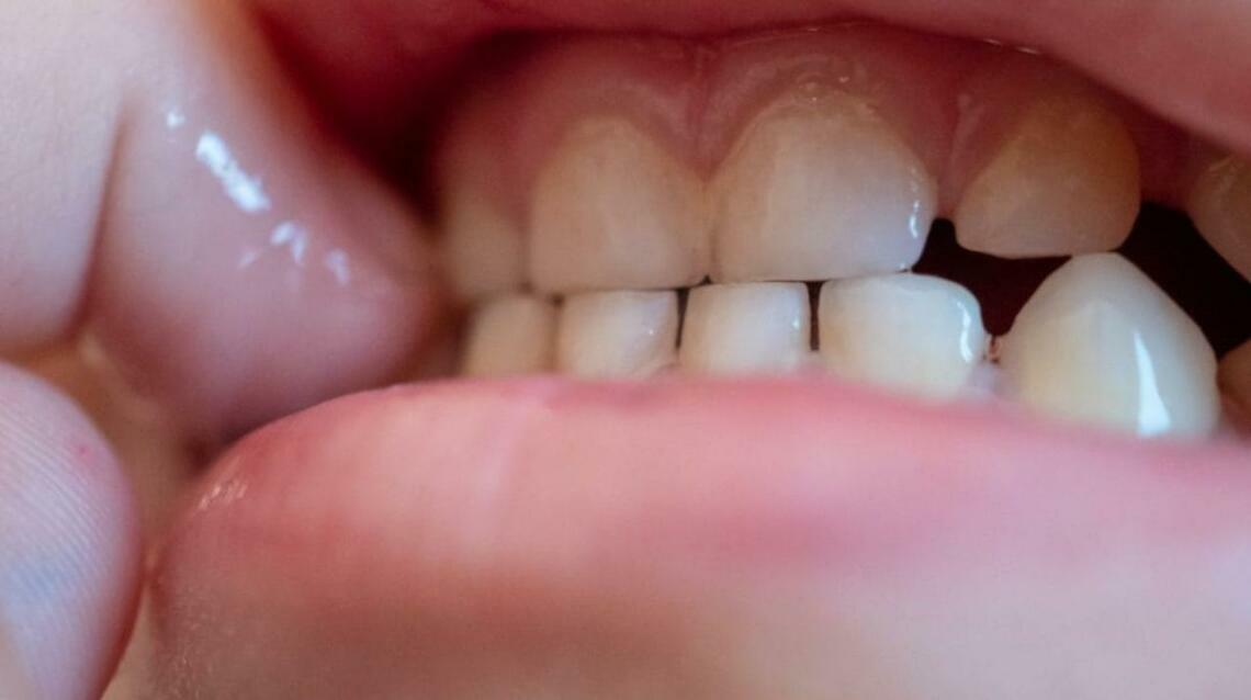 Why Do Some Children Grind Their Teeth During Sleep?