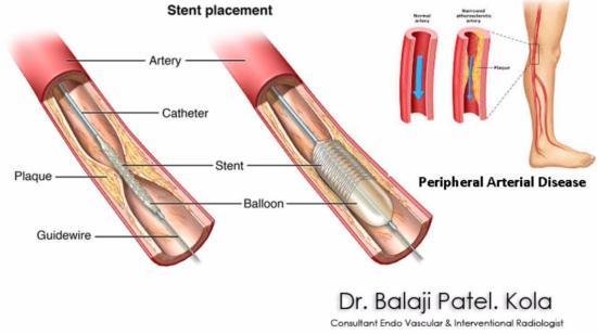 Simple Leg Pain Can Be Dangerous Peripheral Arterial Disease- Know How