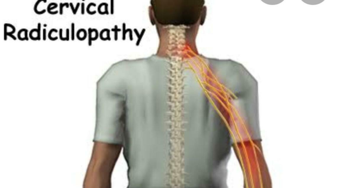 Cervical Radiculopathy