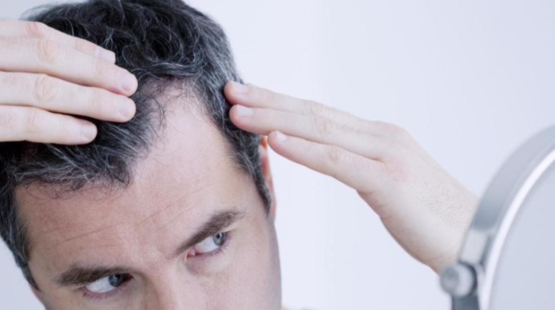 Male Pattern Hair Loss or Heredity?