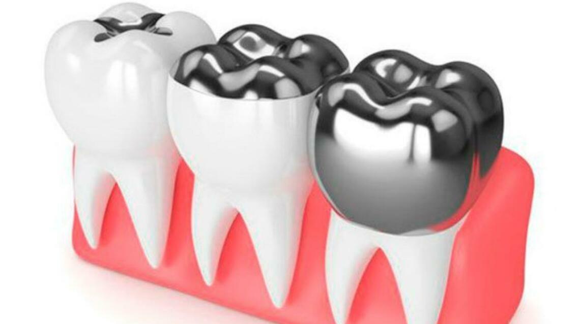 Dental Amalgam Fillings: Facts, Myths, Safety & Modern Relevance